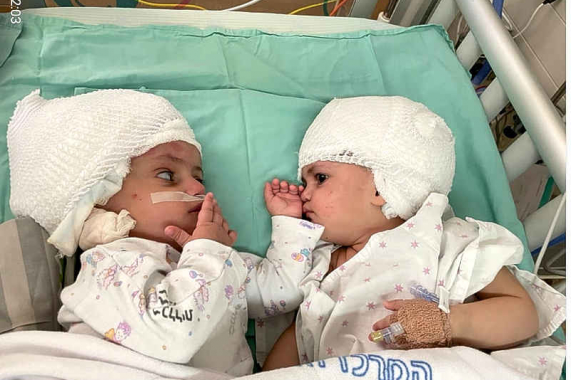 Born conjoined back-to-back, twins finally see each other after surgery
