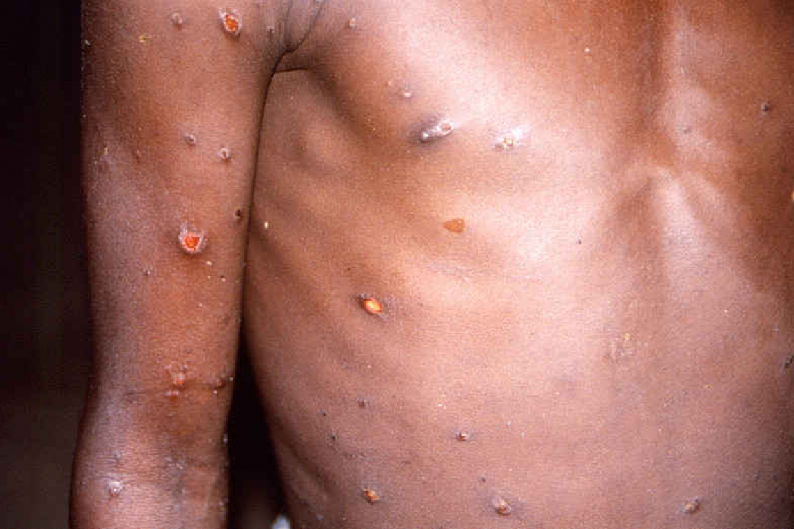 Massachusetts identifies first 2022 US case of monkeypox infection