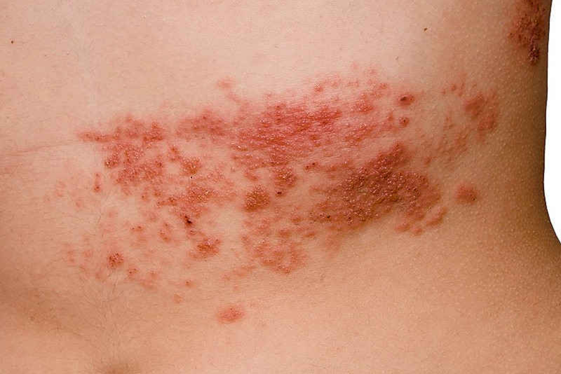 What could you do to avoid shingles?