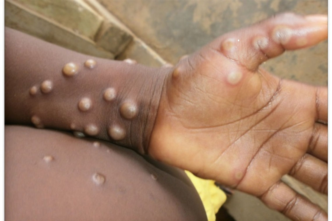 Three new Mpox cases  detected in Barbados