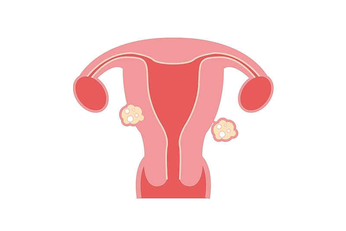 Fibroids – an all too common challenge in young women   